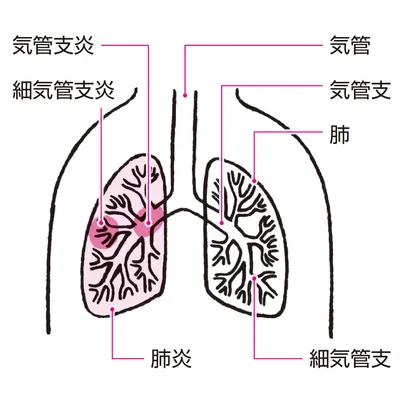 急性気管支炎