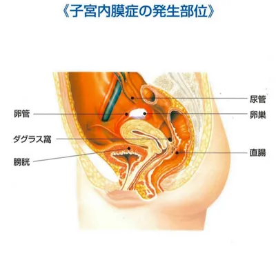 子宮内膜症の発生部位　スクリーンショット 2021-06-08 12.41.32