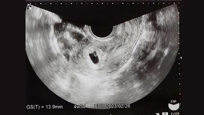 妊娠4週（2ヶ月）頃のエコー写真