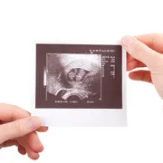 双子の妊娠で起こるバニシングツインとは？原因や赤ちゃんへの影響も解説