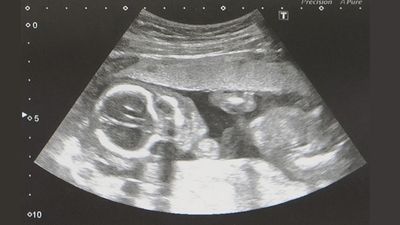 妊娠19週頃の赤ちゃんのエコー