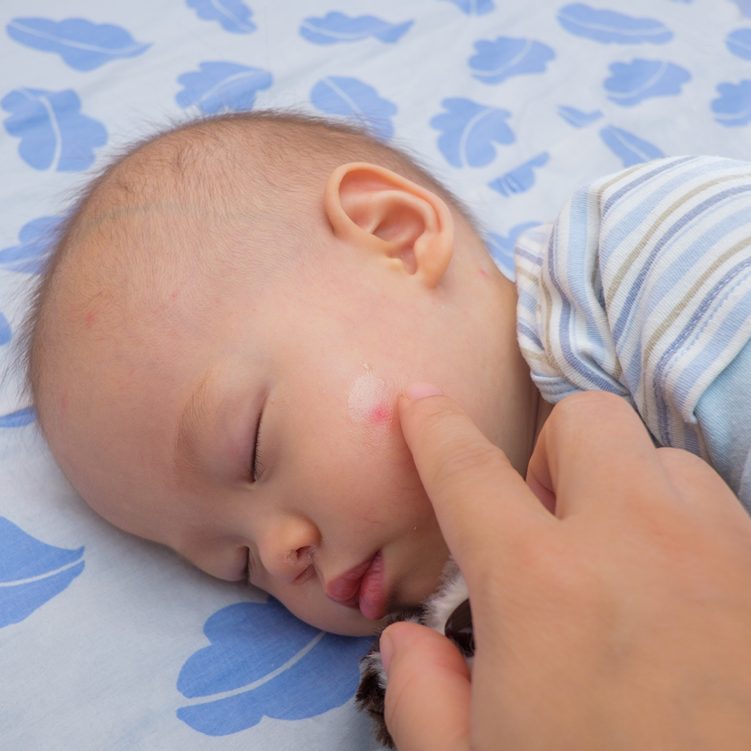 赤ちゃんと子どものアレルギー性の病気体験談 アトピー性皮膚炎 Mamadays ママデイズ