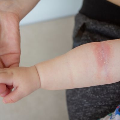 【 赤ちゃんと子どものアレルギー性の病気体験談 】アトピー性皮膚炎