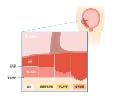 癒着胎盤種類