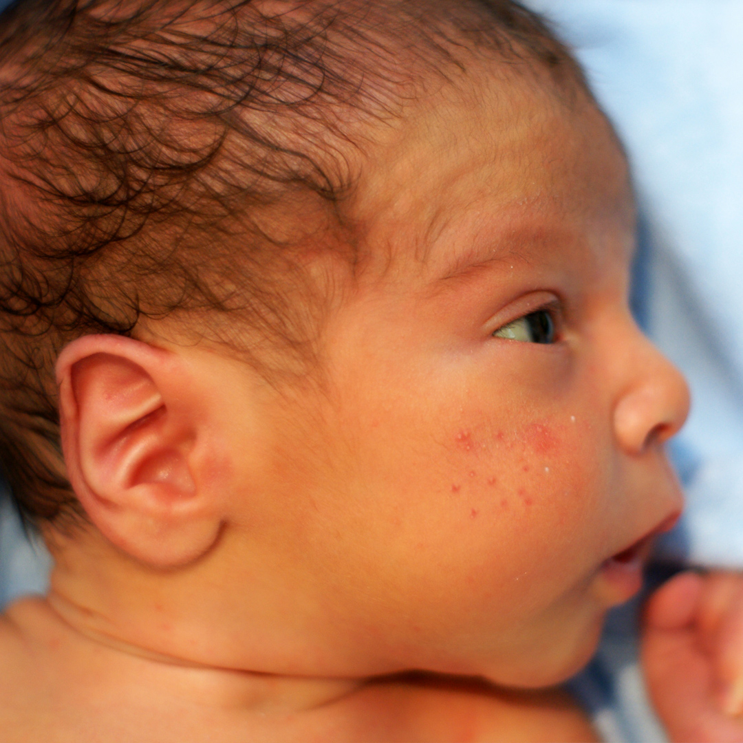 小児科医監修 赤ちゃんと子どもの症状別ホームケア 発疹があるとき考えられる病気 Mamadays ママデイズ