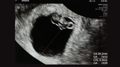 妊娠7週頃の赤ちゃんのエコー