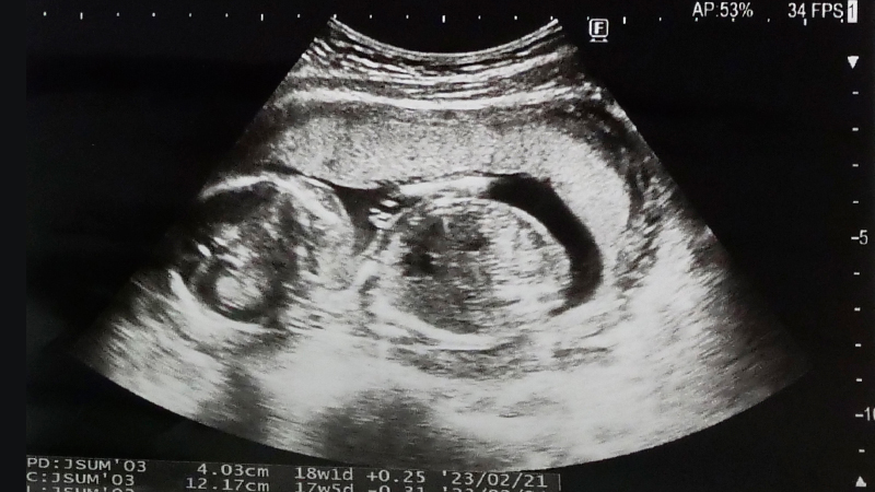 妊娠18週頃の赤ちゃんのエコー