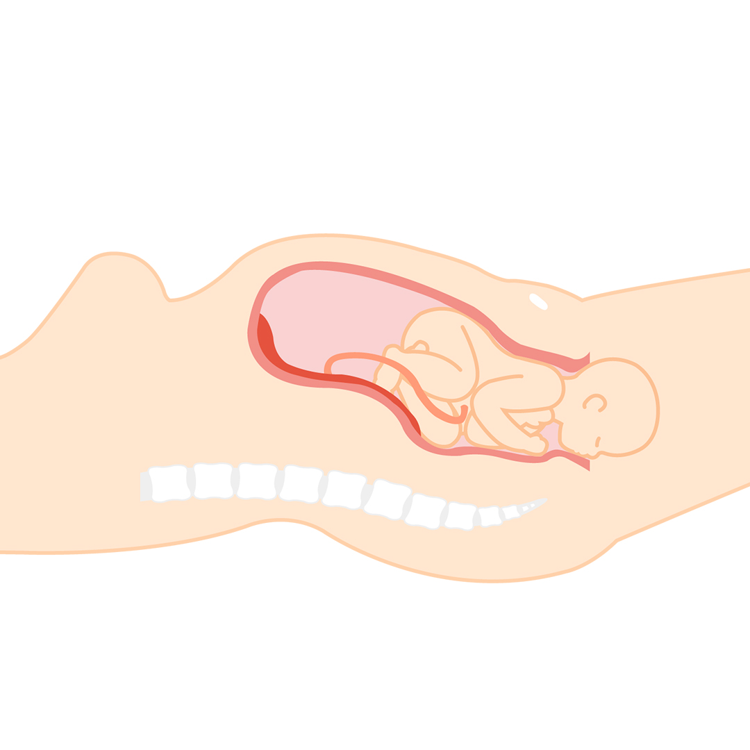 医師監修 妊娠初期に出血 切迫流産かも その症状と原因は Mamadays ママデイズ