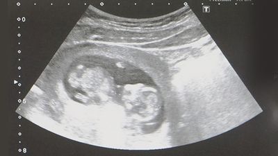 妊娠12週頃の赤ちゃんのエコー