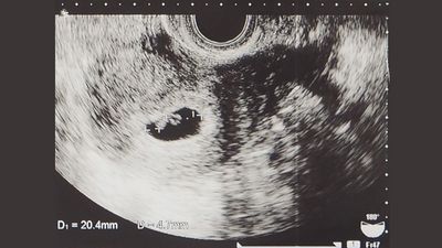 妊娠5週頃の赤ちゃんのエコー
