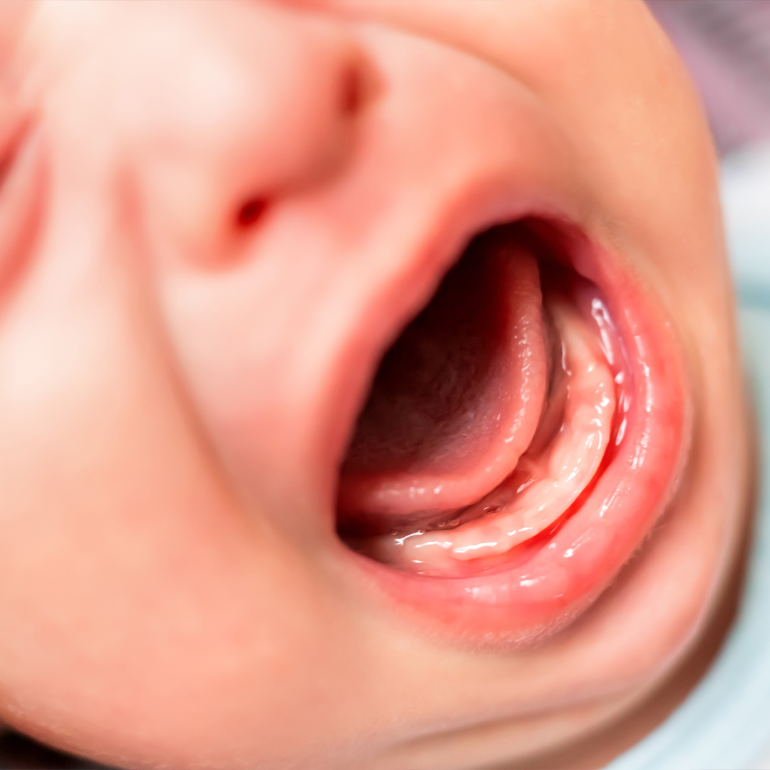 小児科医監修 赤ちゃんと子どもの症状別ホームケア 口内の異常から考えられる病気 Mamadays ママデイズ