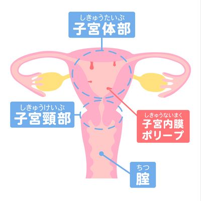 子宮内膜ポリープの説明