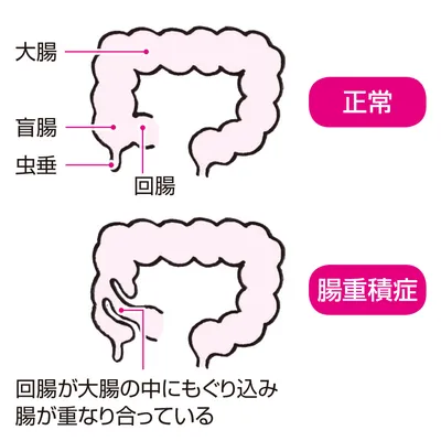 腸重積症イラスト