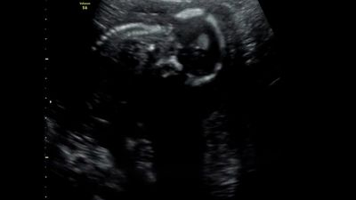 妊娠16週頃の赤ちゃんのエコー