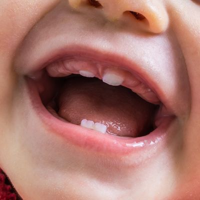 乳歯の歯並びが悪い？すきっ歯・斜めに生えたら？