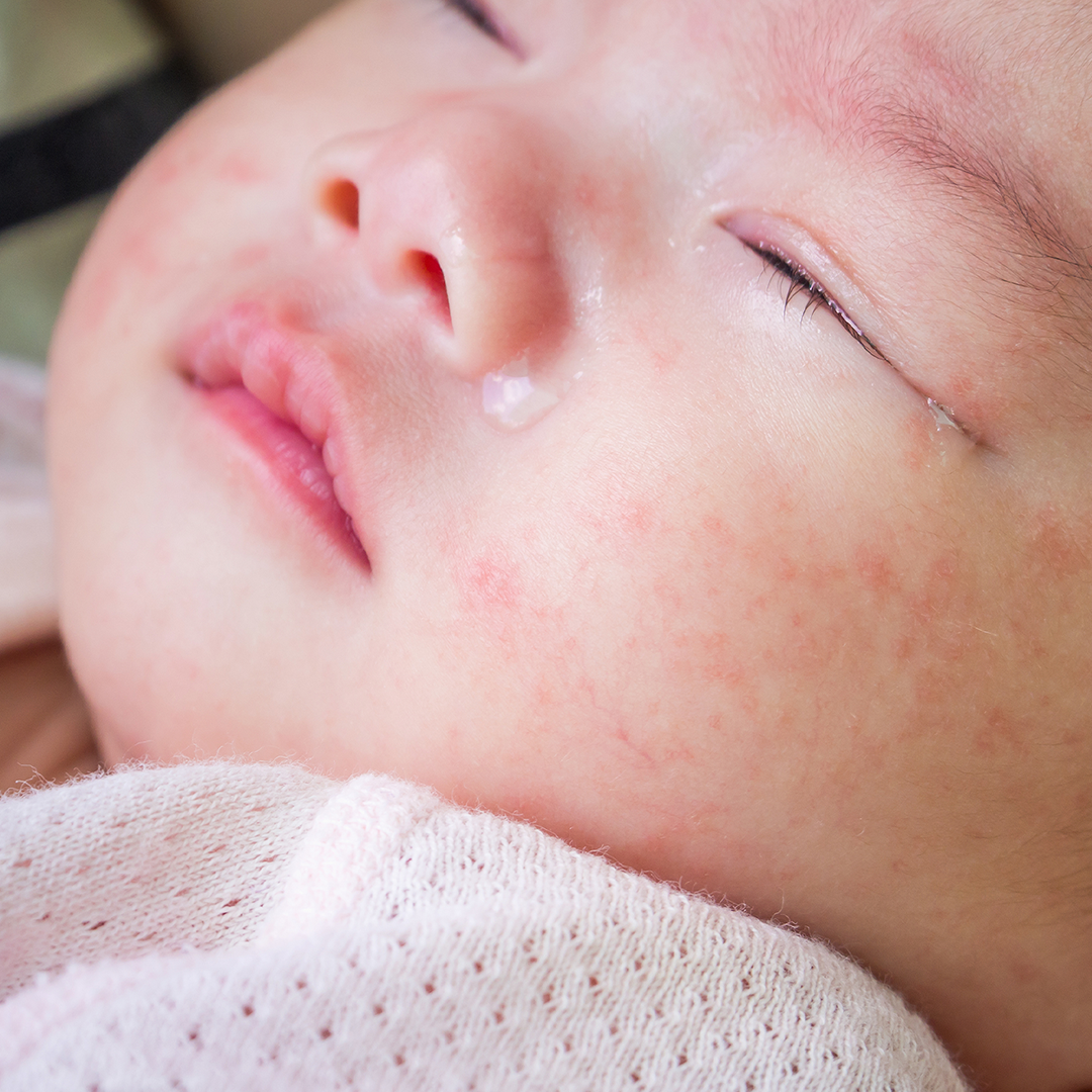 小児科医監修 赤ちゃんと子どもの症状別ホームケア 発疹があるとき考えられる病気 Mamadays ママデイズ