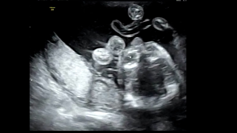 妊娠20週頃の赤ちゃんのエコー